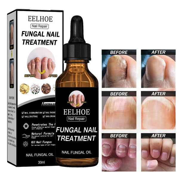 EELHOE Fungus™ Léčba plísňových nehtů